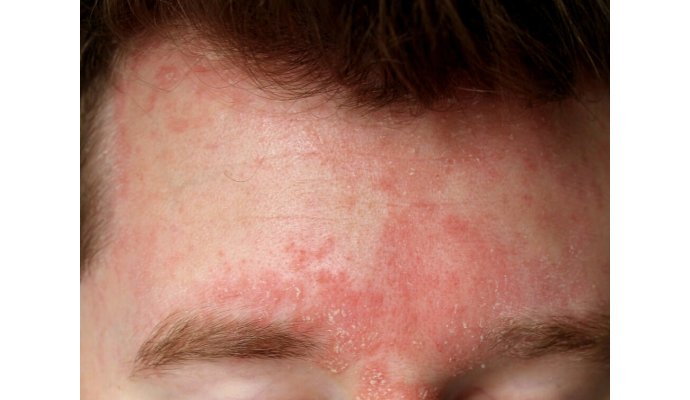 Cos'è la dermatite seborroica e come curarla al meglio