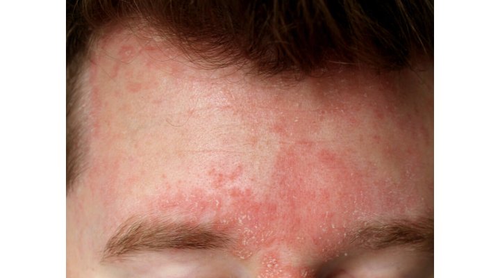 Cos'è la dermatite seborroica e come curarla al meglio